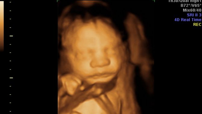 3D Ultrasound of our little man!