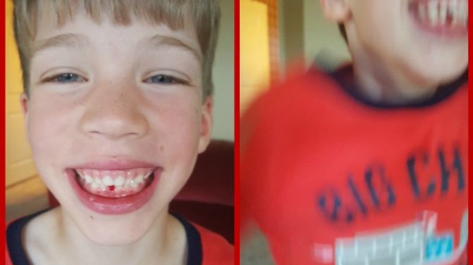 Elliott’s first missing teeth!