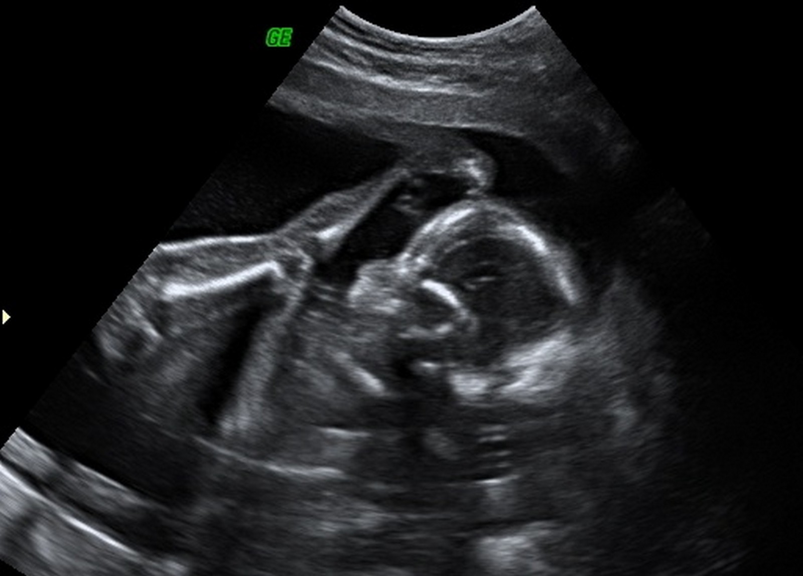 The Tale of the Second Chromosome